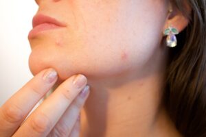 Pokrzywa z trawą cytrynową – szybko pozbądź się pryszczy i trądziku